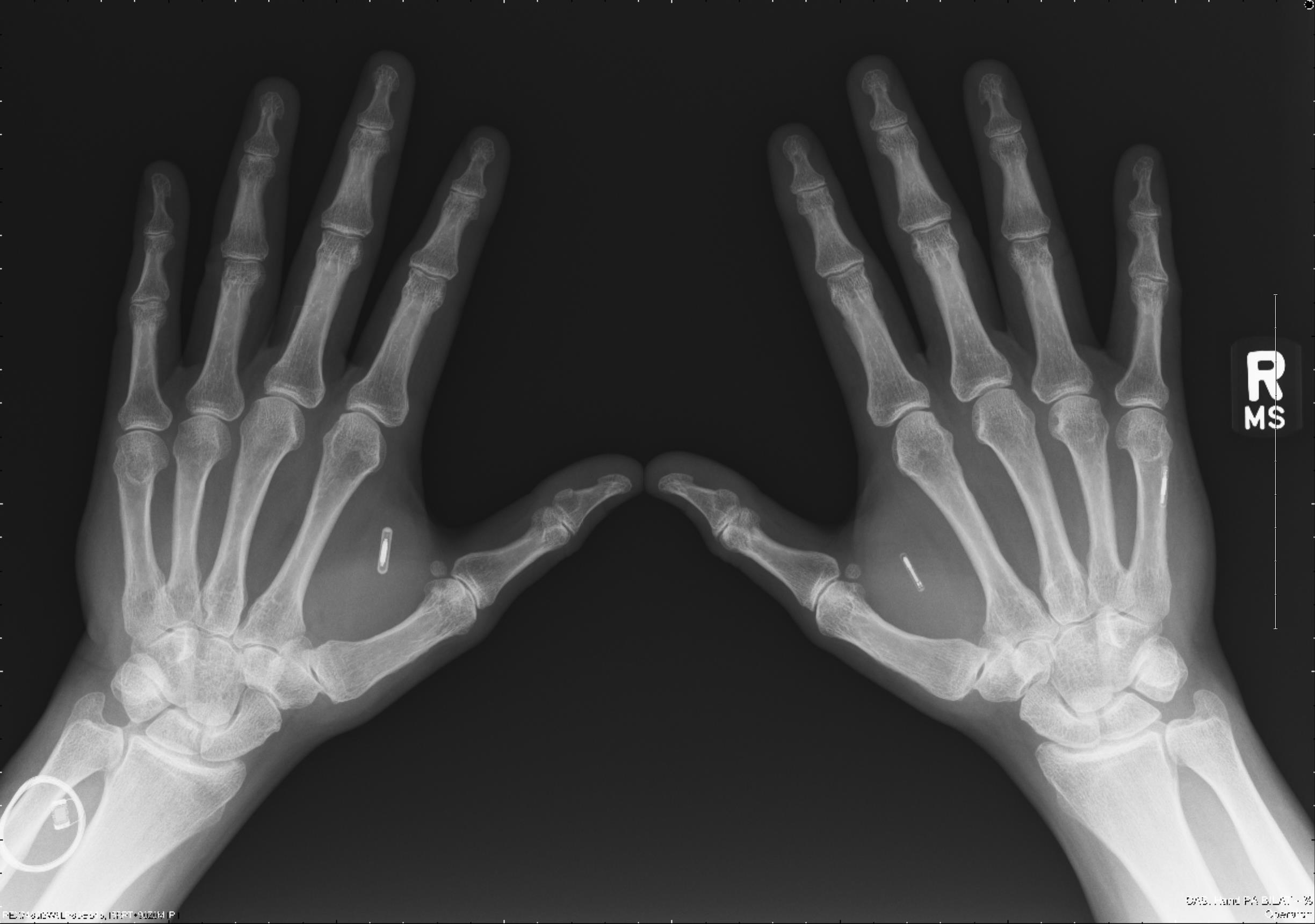 Radiograph of Amal Graafstra's hands showing the implanted RFID and NFC glass-capsule transponders in the webbing between thumb and index finger